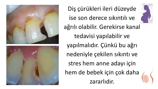 Gebelikte diş kök iltihabının anne ve bebek sağlığı üzerindeki olası etkileri