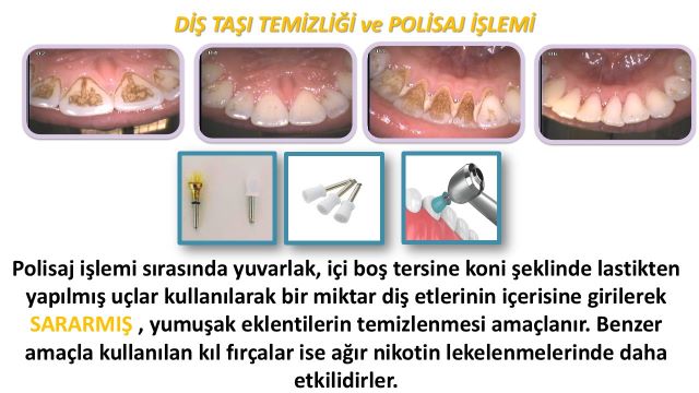 klinikte yapılan profesyonel diş taşı temizleme işlemi
