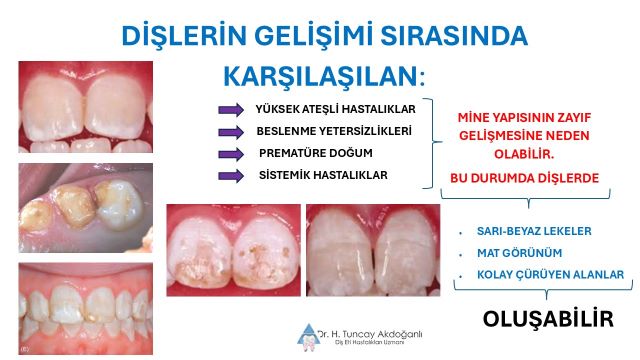 dişlerde yapı bozuklukları sonucu görünen renk değişimleri
