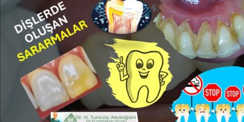 diş sararması neden olur ve nasıl geçer
