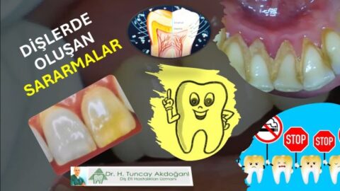 diş sararması neden olur ve nasıl geçer