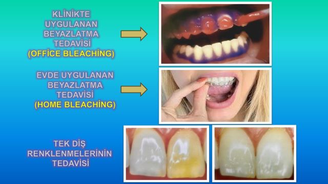 ev tipi diş beyazlatma plağı uygulaması