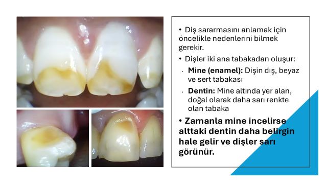 yaş ilerledikçe dişlerde oluşan sararmanın nedenleri