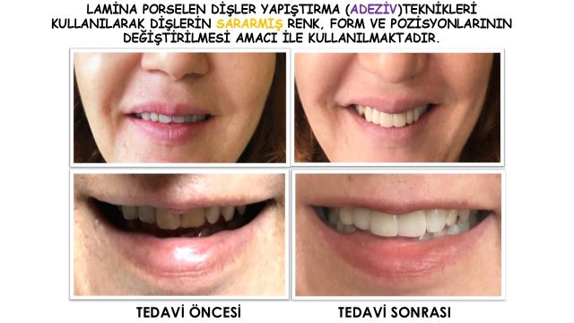 sararmış dişlerin tedavisinde kullanılan yöntemler