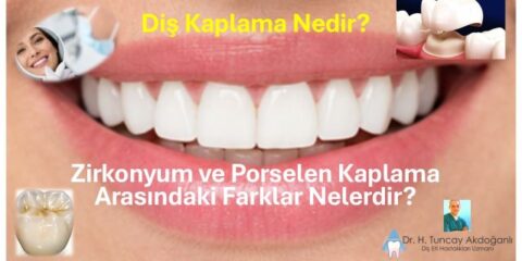 diş kaplama türleri karşılaştırması