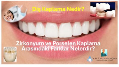 diş kaplama türleri karşılaştırması