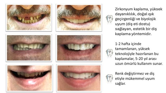 diş kaplama öncesi ve sonrası görünüm