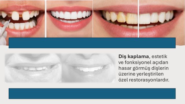 zirkonyum diş kaplama estetik sonucu