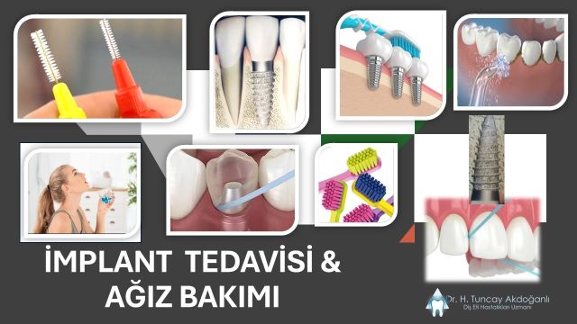 İmplant sonrası dikkat edilmesi gereken bakım ve hijyen ipuçları