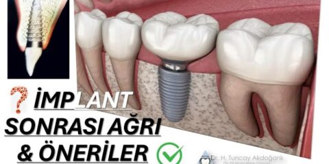 İmplant sonrası ağrı yaşayan hastanın diş ve çene bölgesi