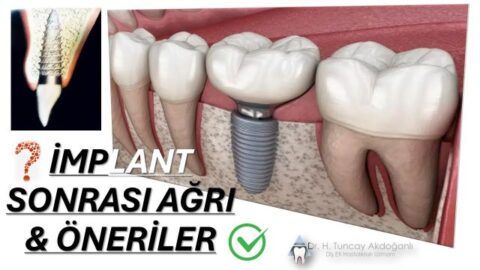 İmplant sonrası ağrı yaşayan hastanın diş ve çene bölgesi