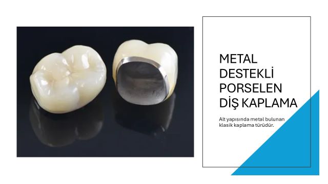 metal destekli porselen diş kaplama