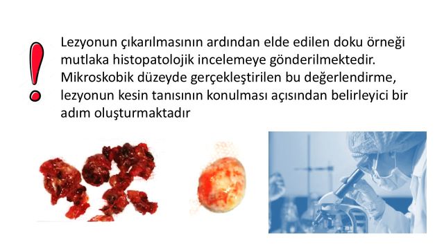 çene kistinin patolojik değerlendirilmesi