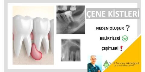 çene kisti neden olur, belirtileri nelerdir?