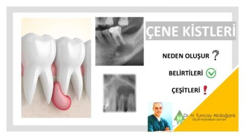 çene kisti neden olur, belirtileri nelerdir?