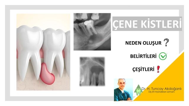 çene kisti neden olur, belirtileri nelerdir?