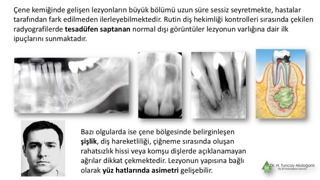 Kistlerin röntgen görüntüsü