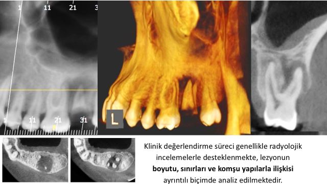 Kistlerin çenelerde teşhis edilmesi