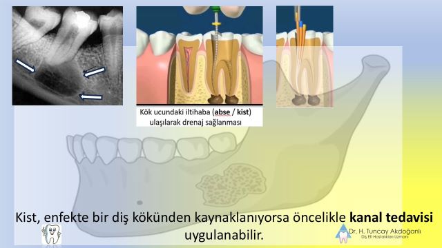 Çene kistlerinin tedavisinde kanal tedavisi