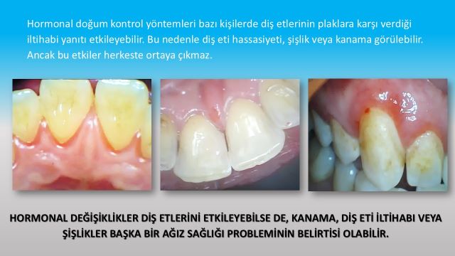 Doğum kontrol hapının diş etlerine olası etkileri