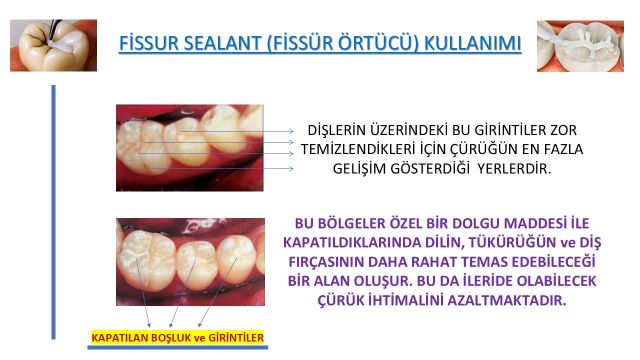 Çocuklarda diş çürüğünü önlemek için fissür örtücü uygulaması