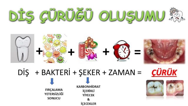 Diş çürüğü oluşumunda diş, bakteriler, şeker ve zamanın etkisini gösteren şema